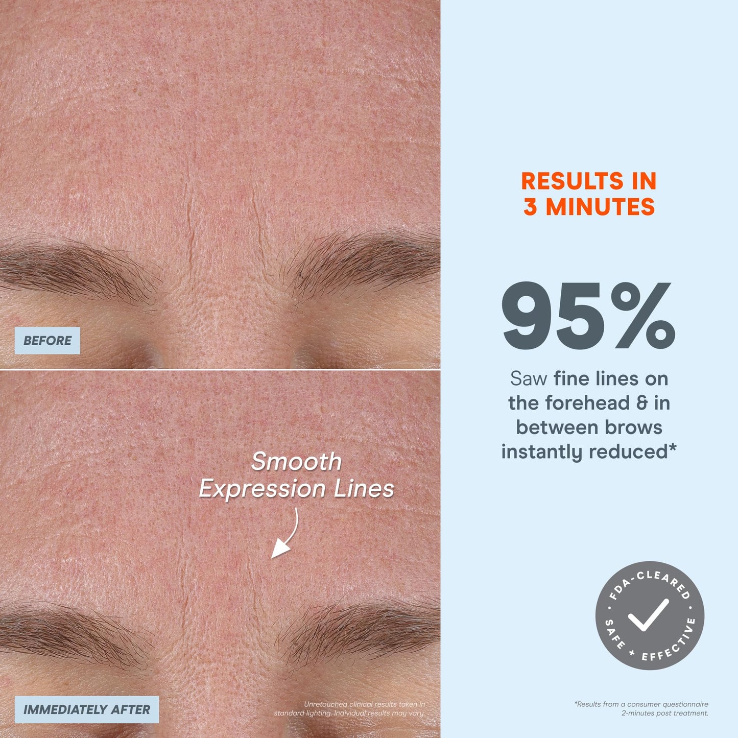 NuFACE FIX MicroWand Microcurrent Facial Device, FDA Cleared - Eyes, Lips & Lines Treatment with Serum Activator - Lip Plumper, Eye Depuffing Wand, Wrinkle & Smile Line Reducer, 3 On-The-Go Modes